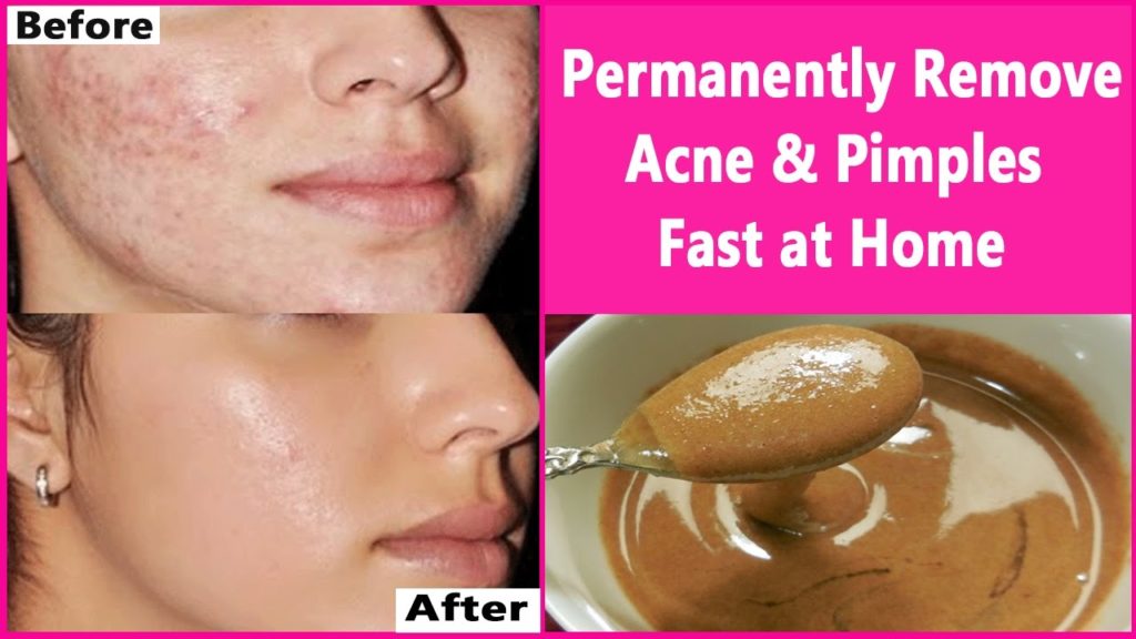 ways to clear acne fast home remedies
