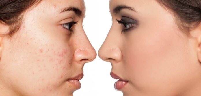 Best Acne Treatment Product on Amazon