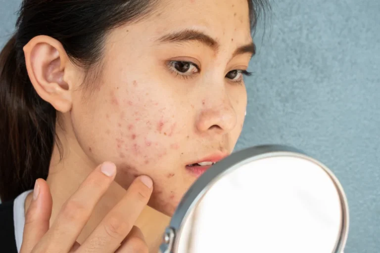 Suffering From Severe Adult Acne? Checkout This Acne Treatment in Singapore